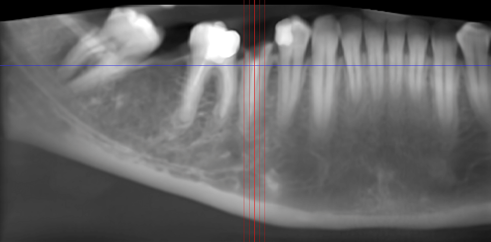 CBCT-depicting-panoramic-view