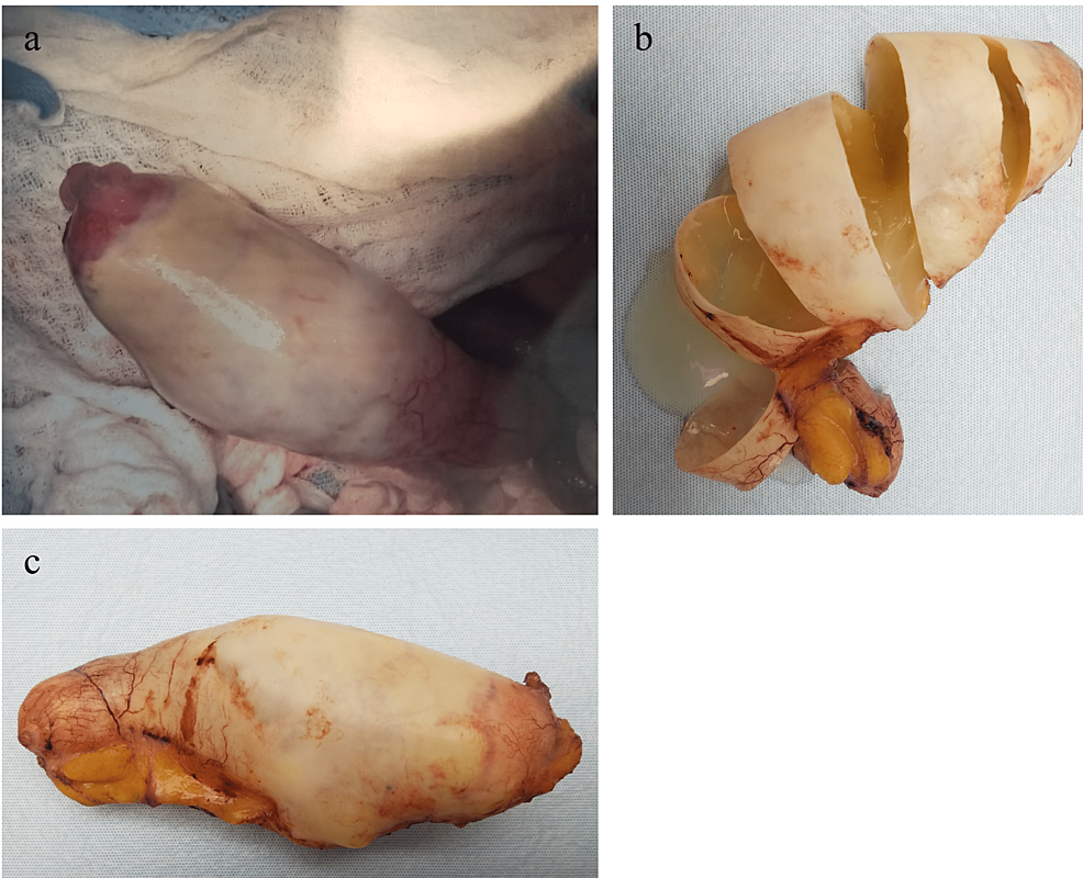 Gross-appendiceal-specimen-of-Case-3-(1a-c).-Appendix-is-grossly-distended,-with-cut-surfaces-showing-mucin-filled-lumen.-Specimens-with-LAMN,-as-in-this-case,-can-grossly-present-as-dilated-mucinous-appendices.-Pathology-of-this-specimen-showed-LAMN.
