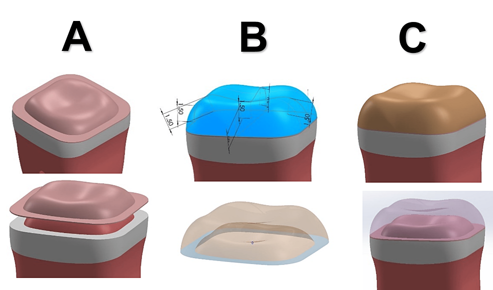 3D-models-of-the-onlays:-(A)-cement-layer,-(B)-dimension-of-onlay,-and-(C)-onlay