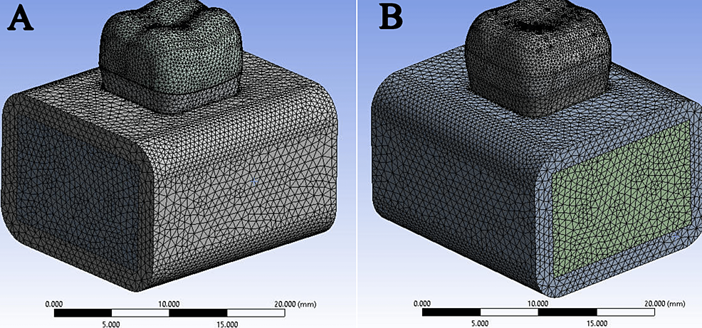 Meshing-process:-(A)-full-crowns-and-(B)-onlay
