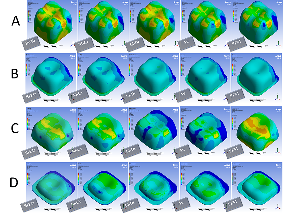 Stress-distribution-in-600-N-vertical-forces:-(A)-full-crown-restorations,-(B)-full-crown-luting-cement,-(C)-onlays-restorations,-and-(D)-onlays-luting-cement