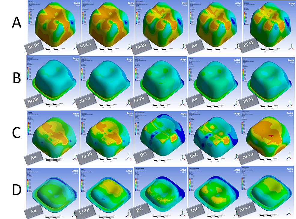 Stress-distribution-in-1000-N-vertical-forces:-(A)-full-crown-restorations,-(B)-full-crown-luting-cement,-(C)-onlays-restorations,-and-(D)-onlays-luting-cement