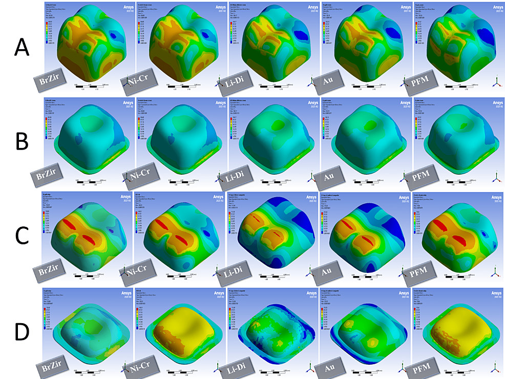 Stress-distribution-in-600-N-oblique-forces:-(A)-full-crown-restorations,-(B)-full-crown-luting-cement,-(C)-onlays-restorations,-and-(D)-onlays-luting-cement