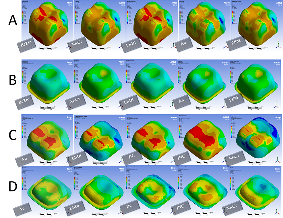 Stress-distribution-in-1000-N-vertical-forces-with-600-N-oblique-forces:-(A)-full-crown-restorations,-(B)-full-crown-luting-cement,-(C)-onlays-restorations,-and-(D)-onlays-luting-cement